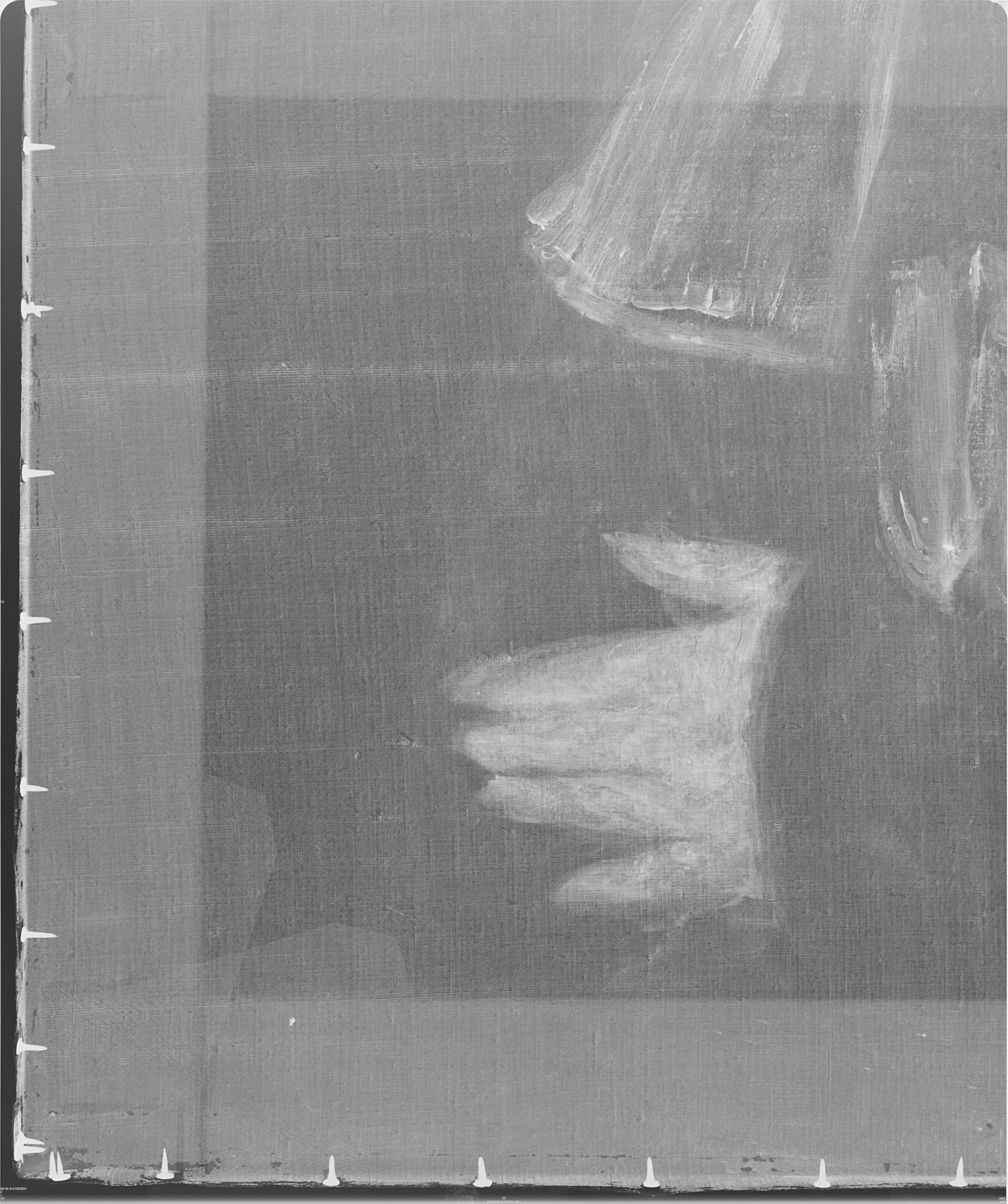 X radiograph showing changes to hand and jabot
